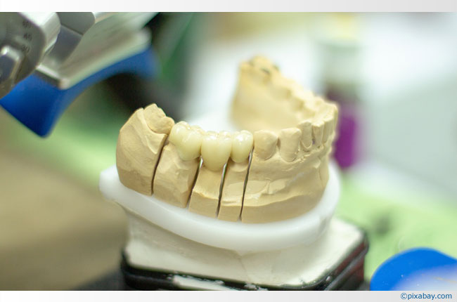 Risiken der Zahnimplantate