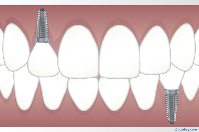 Zahnimplantate machen das Leben leichter